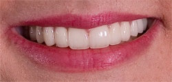 Closeup of Rochelle's smile after treatment