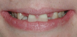 Closeup of Rochelle's smile before treatment