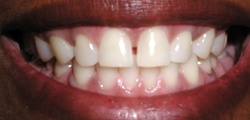 Closeup of Martha's smile before treatment