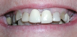 Closeup of Carol's smile before treatment