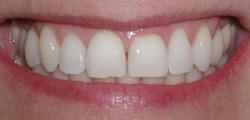 Closeup of Kathy's smile before treatment