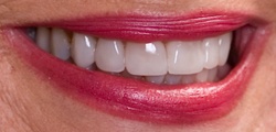 Closeup of JoAnn's smile after treatment