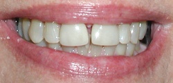 Closeup of JoAnn's smile before treatment