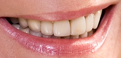 Closeup of Patty's smile after treatment