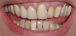 Closeup of Patty's smile before treatment