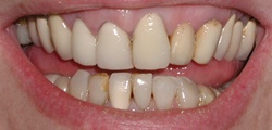 Closeup of Patty's smile before treatment