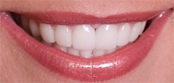 Closeup of Sophia's smile after treatment