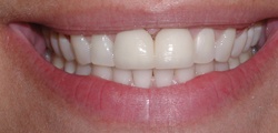 Closeup of Sophia's smile before treatment