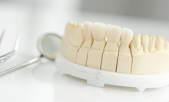 Model smile with fixed bridge restoration