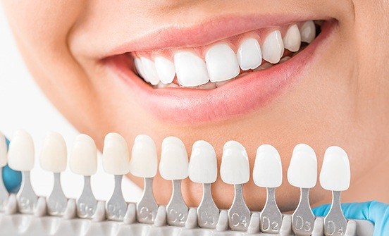 Closeup of smile compared with tooth color chart