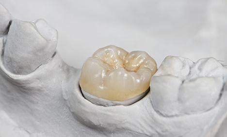 Dental crowns prior placement