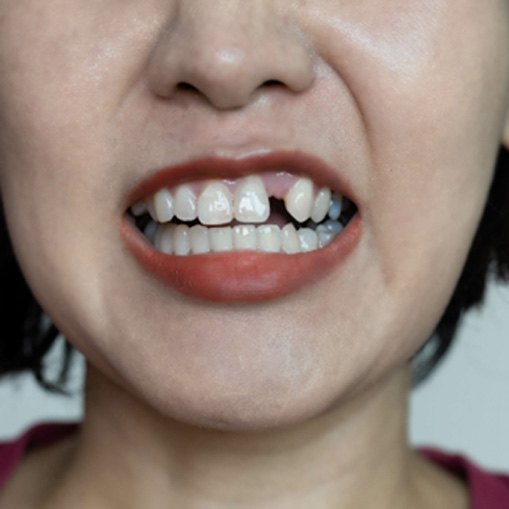 a woman with a missing tooth