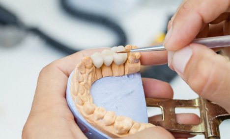 a dental lab technician created a dental bridge