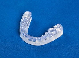 Custom mouthguard from an implant dentist in Clinton Township