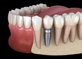 Animation of implant supported dental crown