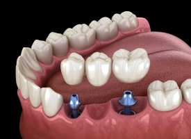 Animation of implant supported fixed bridge