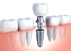 diagram of dental implant post, abutment, and crown
