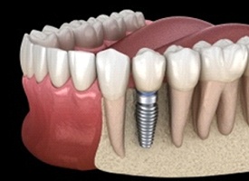 A digital image of a single tooth dental implant sitting on the lower arch between two healthy teeth