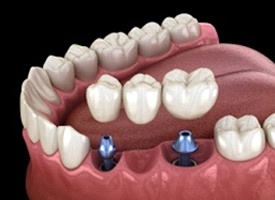 A digital image of a fixed bridge being placed over two dental implants on the lower arch