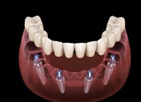 A digital image of four dental implants along the lower arch of the mouth with an implant denture being secured to the tops of the implants