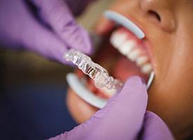 Clinton Township dentist placing Invisalign on patient