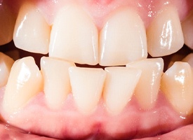 overcrowded teeth needing Invisalign in Atlanta