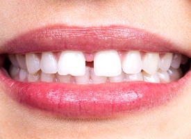 gapped teeth needing Invisalign in Atlanta
