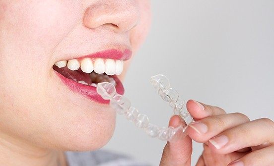 Patient placing clear aligner