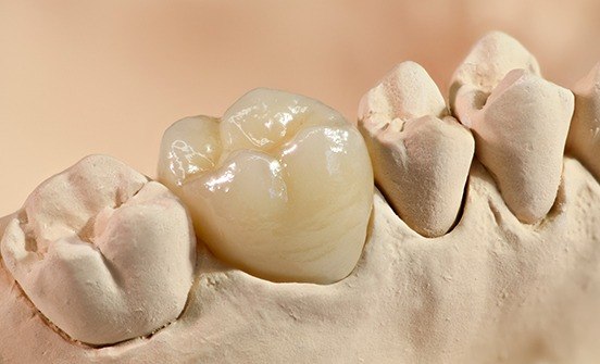 Model smile with dental crown restoration