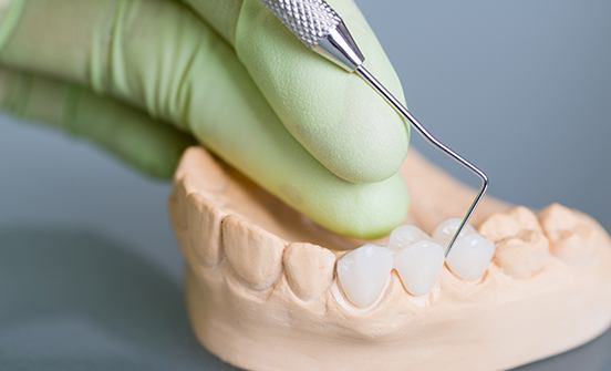 Model smile with fixed bridge restoration