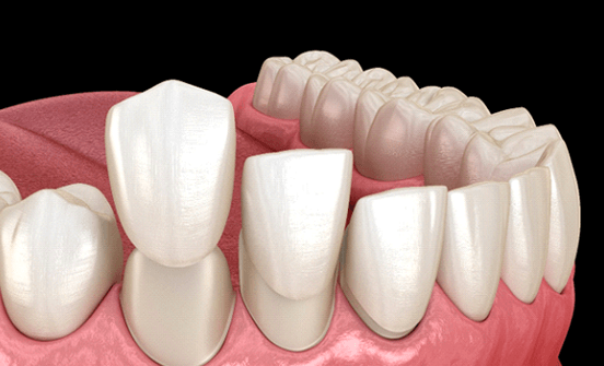 Dental veneers in Clinton Township