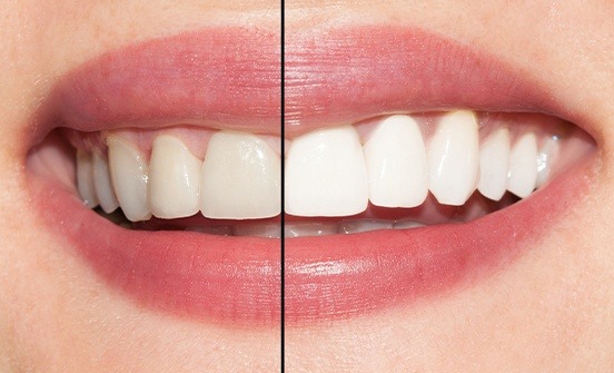 Smile before and after teeth whitening