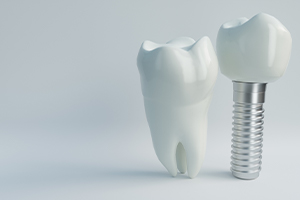 replica of a dental implant